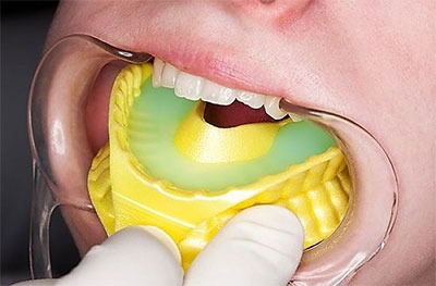 Professional fluoride treatment application